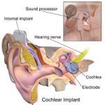 CochlearImplant